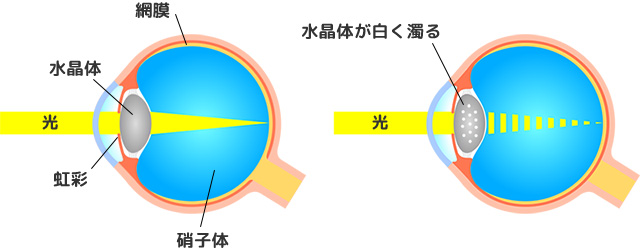 白内障イラスト